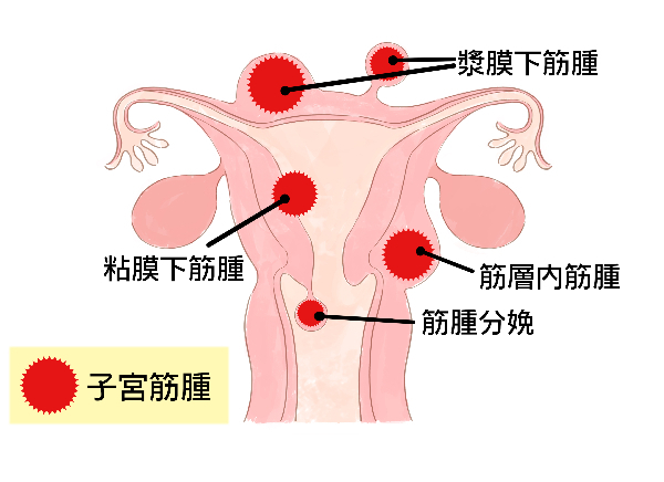 子宮筋腫ができる場所は複数ある。
